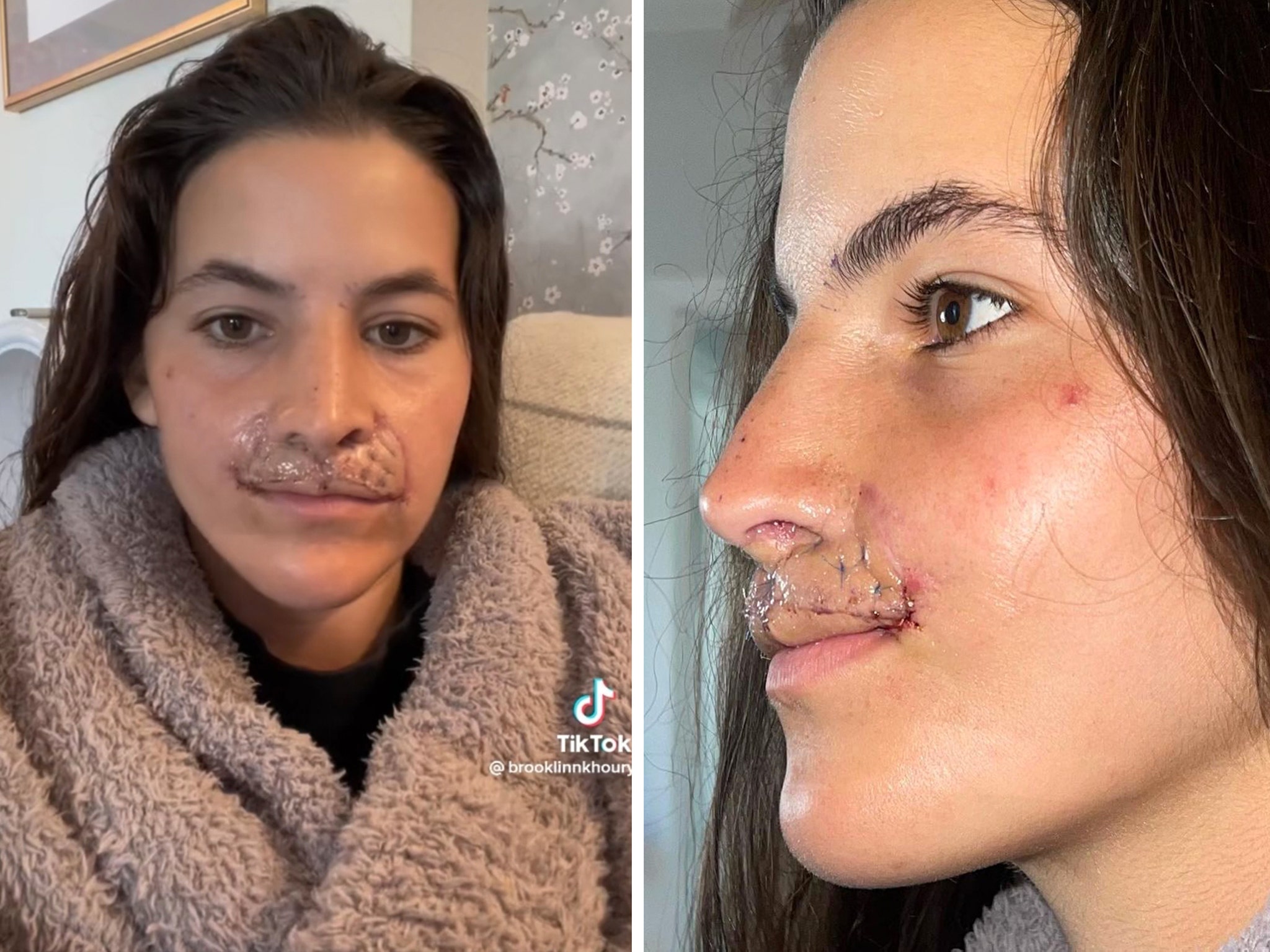 Brooklinn Khoury Shows Off Results of Latest Lip Reconstruction