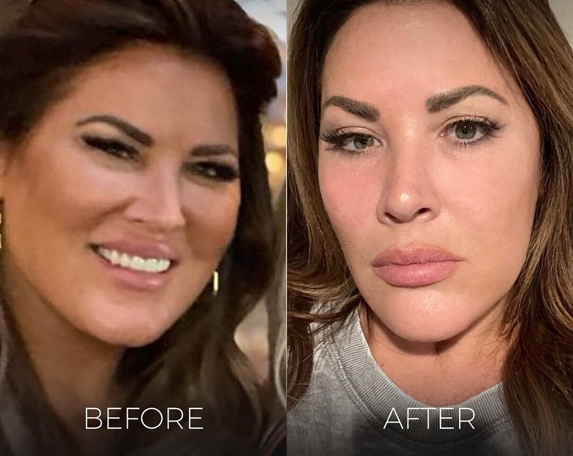 Celebrity Plastic Surgery Reveals and Beauty Confessions of 2021