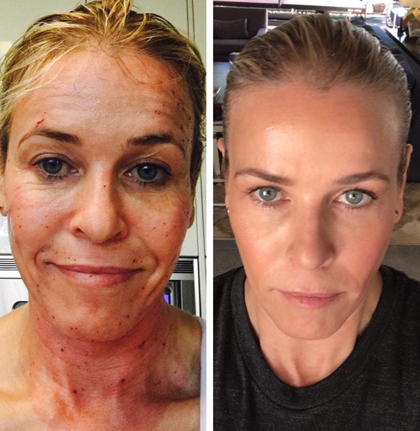 Chelsea Handler's BeforeandAfter Laser Treatment Pics