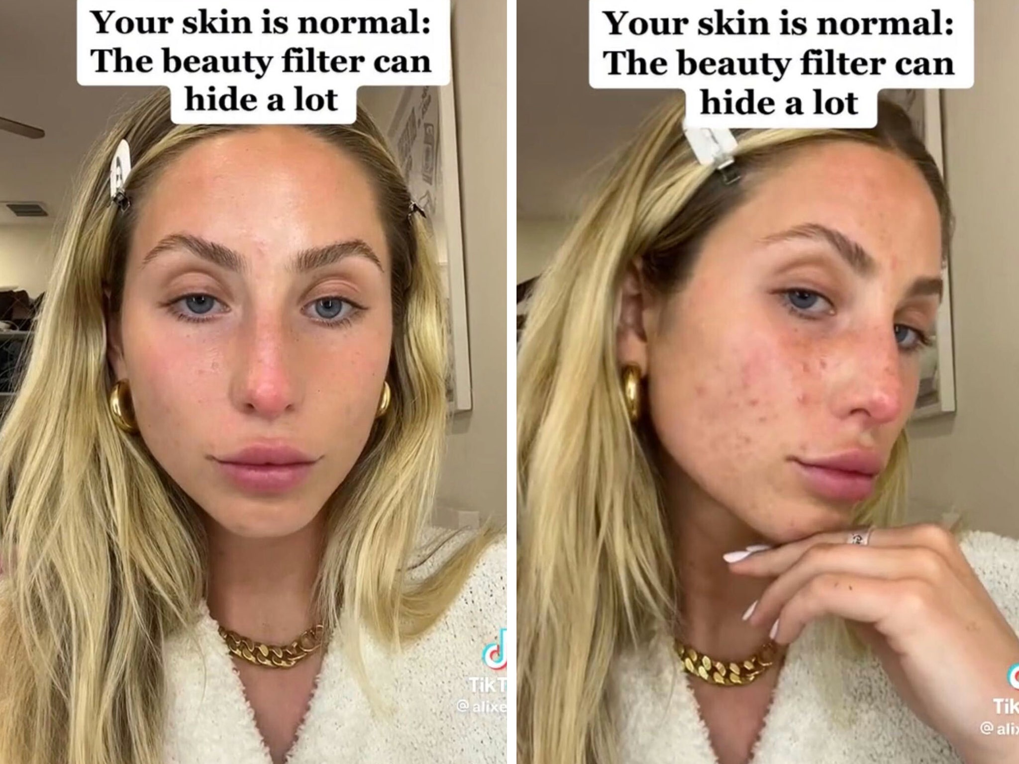 Alix Earle Shares Candid TikTok Video With No Filter Showing Acne