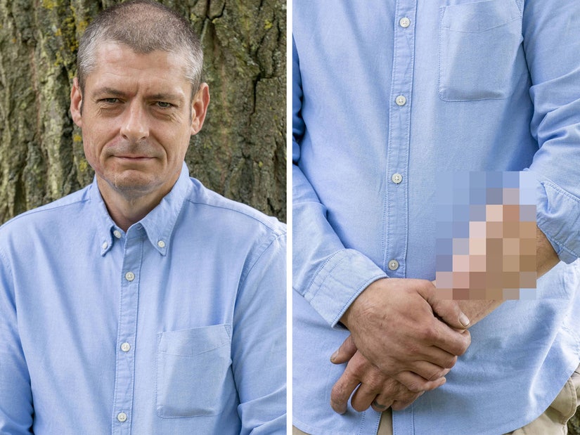 Man Who Had Replacement Penis Grown on His Arm Has Been Stuck With