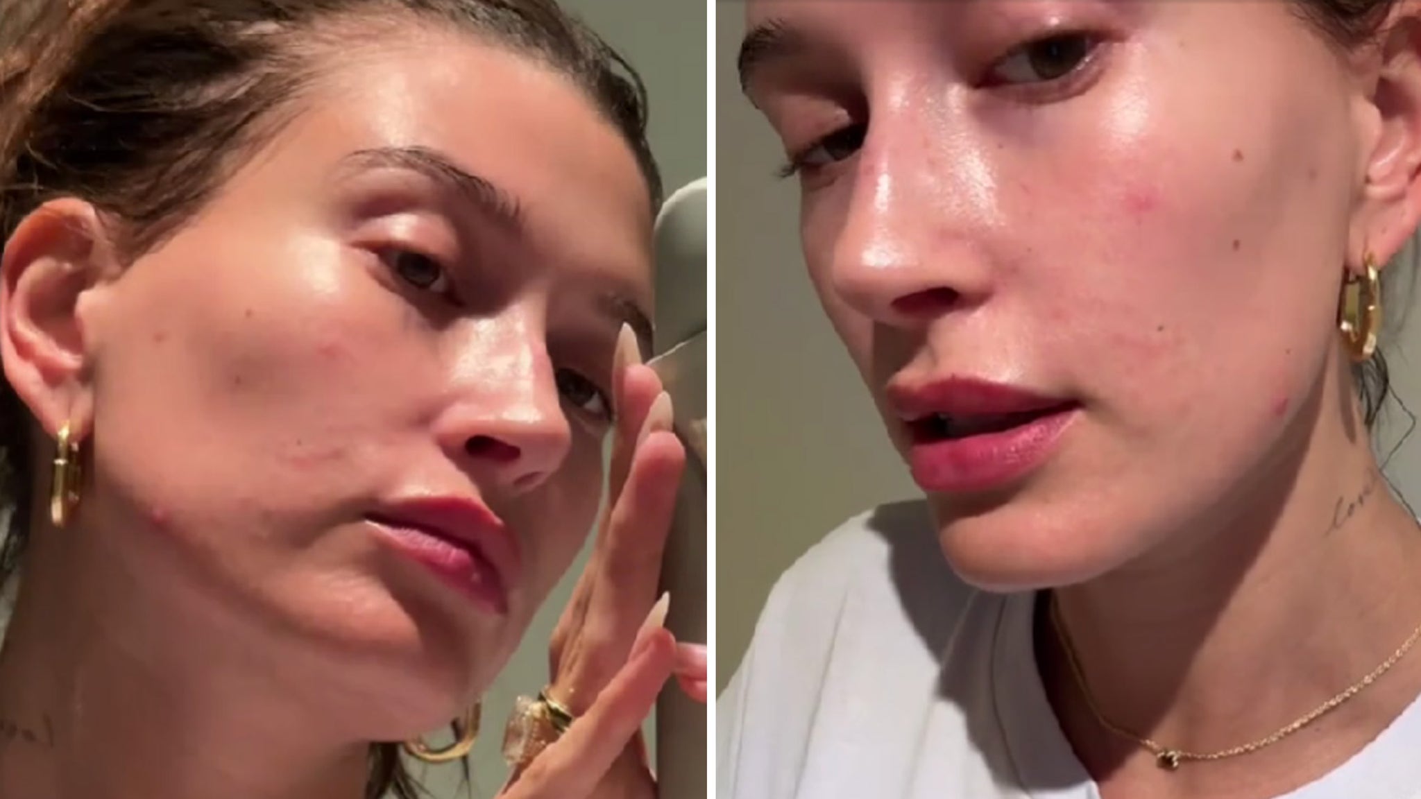 Hailey Bieber Reveals Perioral Dermatitis Flare-Up, Shares How She Treats Skin Condition