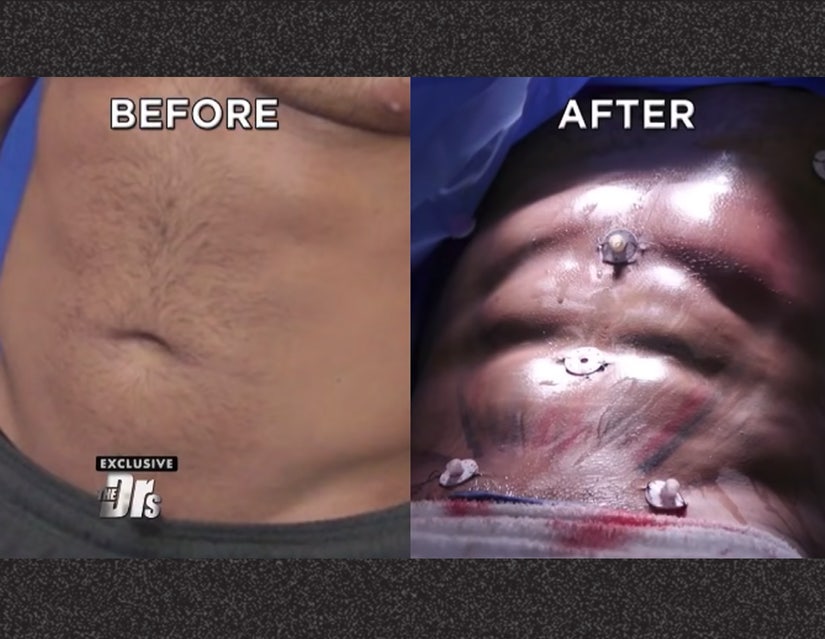 A QUICK WAY TO 6-PACK ABS - PLASTIC SURGERY